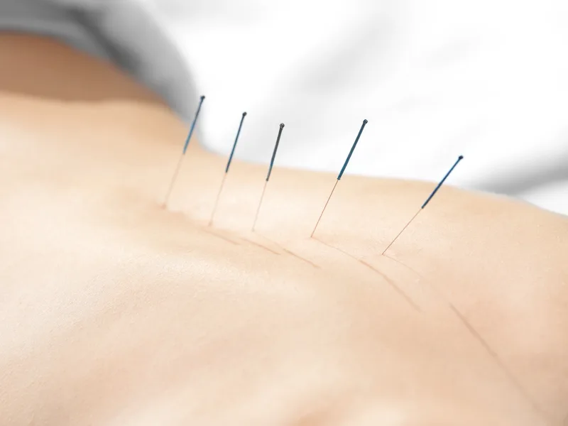 Acupuncture at Aligned Medical Group in Malvern