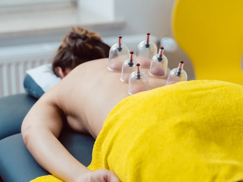 Cupping Therapy at Aligned Medical Group in Malvern