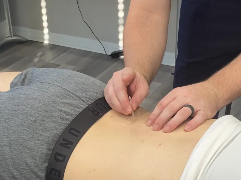 How Dry Needling works at Aligned Medical Group