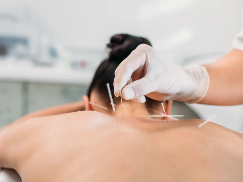 Dry Needling at Aligned Medical Group in Malvern